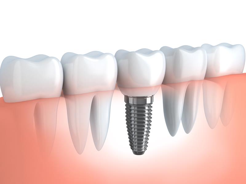Dental Implants Kansas City, MO
