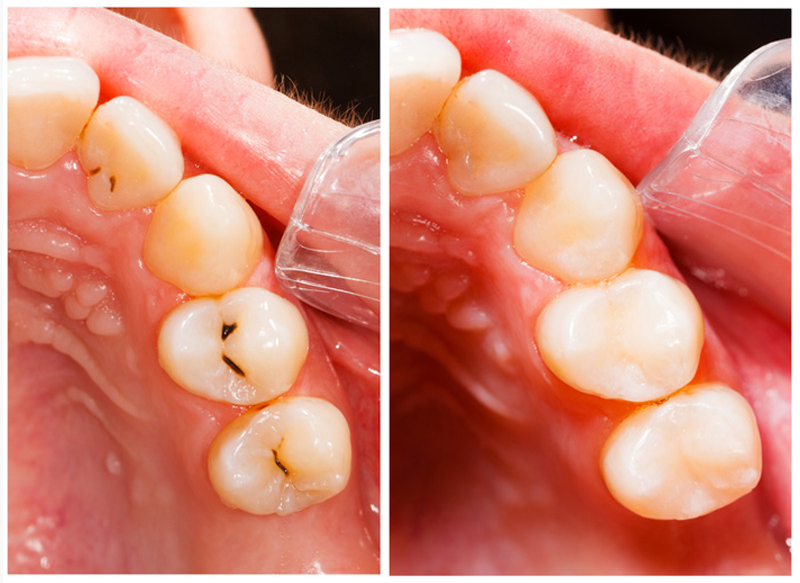 Fillings Kansas City, MO