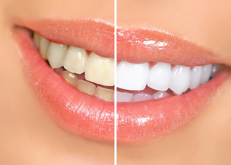 Teeth Whitening Kansas City, MO