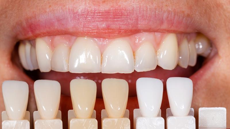 Veneers Kansas City, MO 